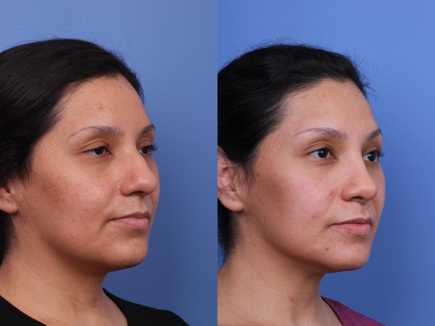 Rhinoplasty Before & After Photo | Scottsdale & Phoenix, AZ | Hobgood Facial Plastic Surgery: Todd Hobgood, MD