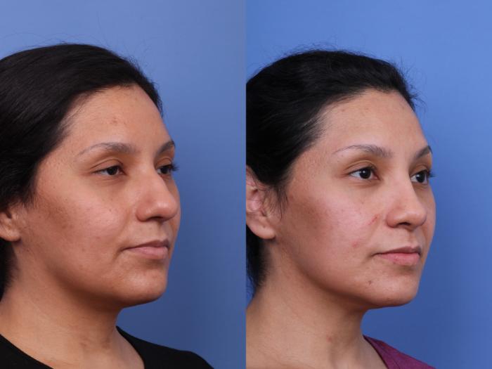 Rhinoplasty Before & After Photo | Scottsdale & Phoenix, AZ | Hobgood Facial Plastic Surgery: Todd Hobgood, MD