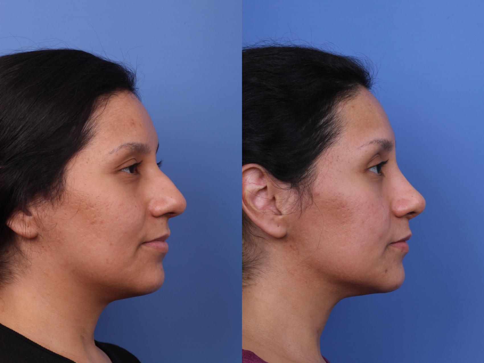 Before & After Rhinoplasty Case 640 Right Side View in Scottsdale, AZ