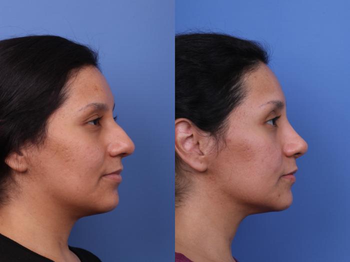 Rhinoplasty Before & After Photo | Scottsdale & Phoenix, AZ | Hobgood Facial Plastic Surgery: Todd Hobgood, MD