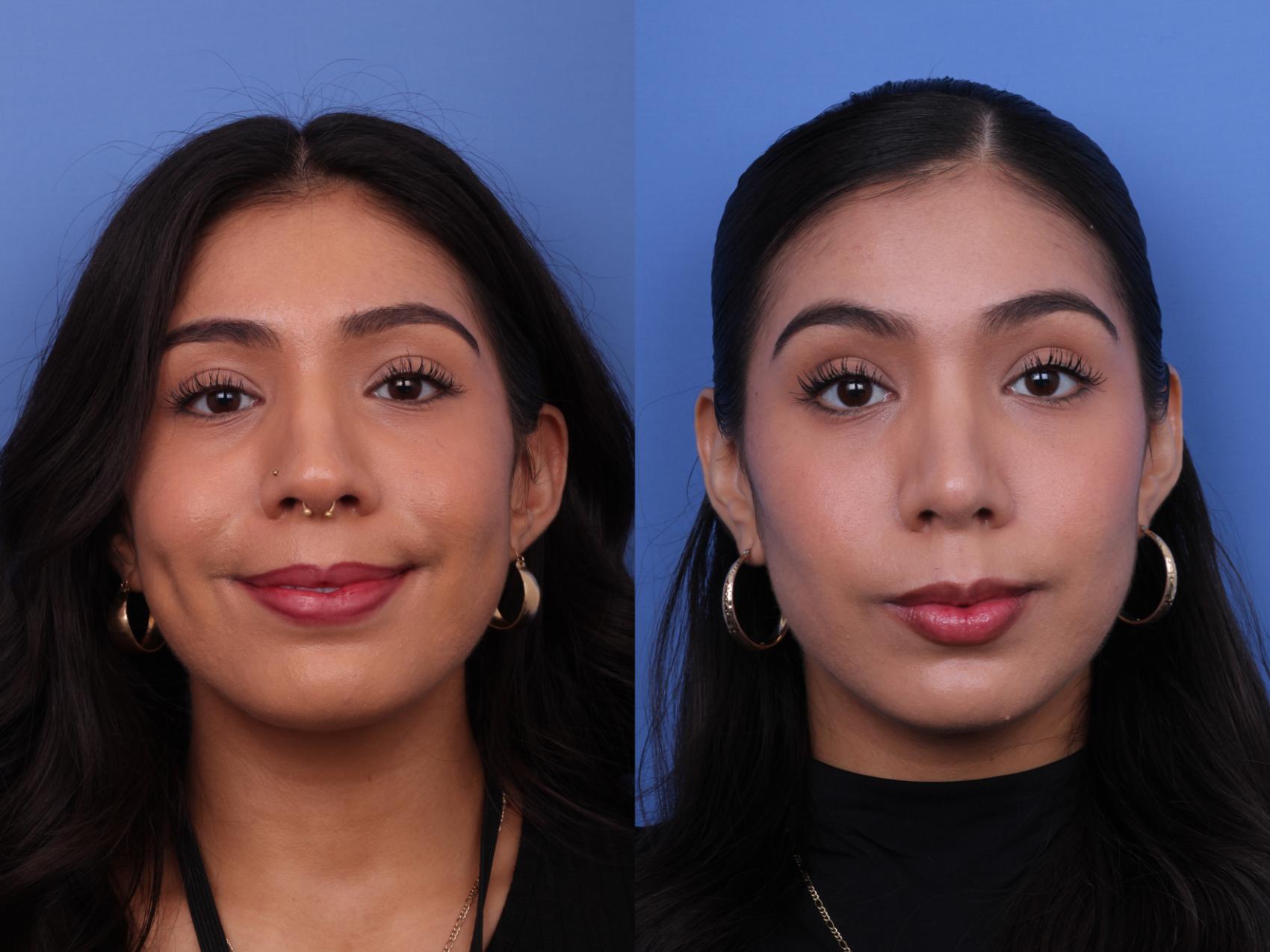 Before & After Rhinoplasty Case 646 Front View in Scottsdale, AZ