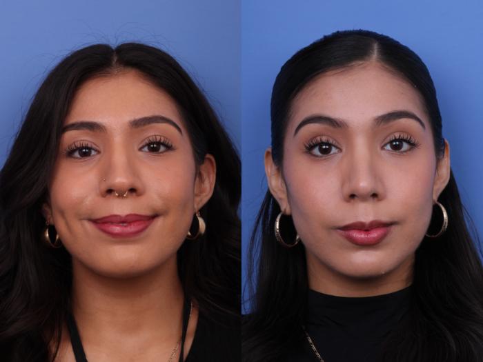 Rhinoplasty Before & After Photo | Scottsdale & Phoenix, AZ | Hobgood Facial Plastic Surgery: Todd Hobgood, MD