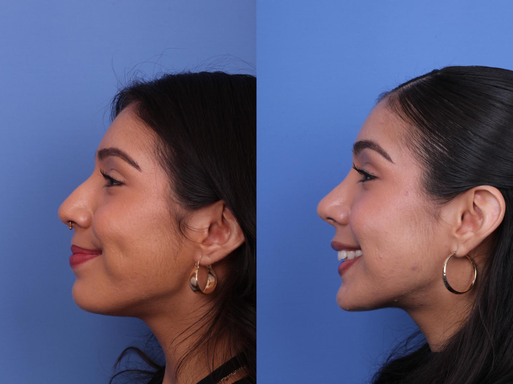 Before & After Rhinoplasty Case 646 Left Smile View in Scottsdale, AZ