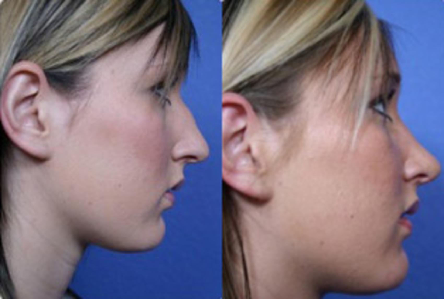 Before & After Rhinoplasty Case 65 View #2 View in Scottsdale, AZ