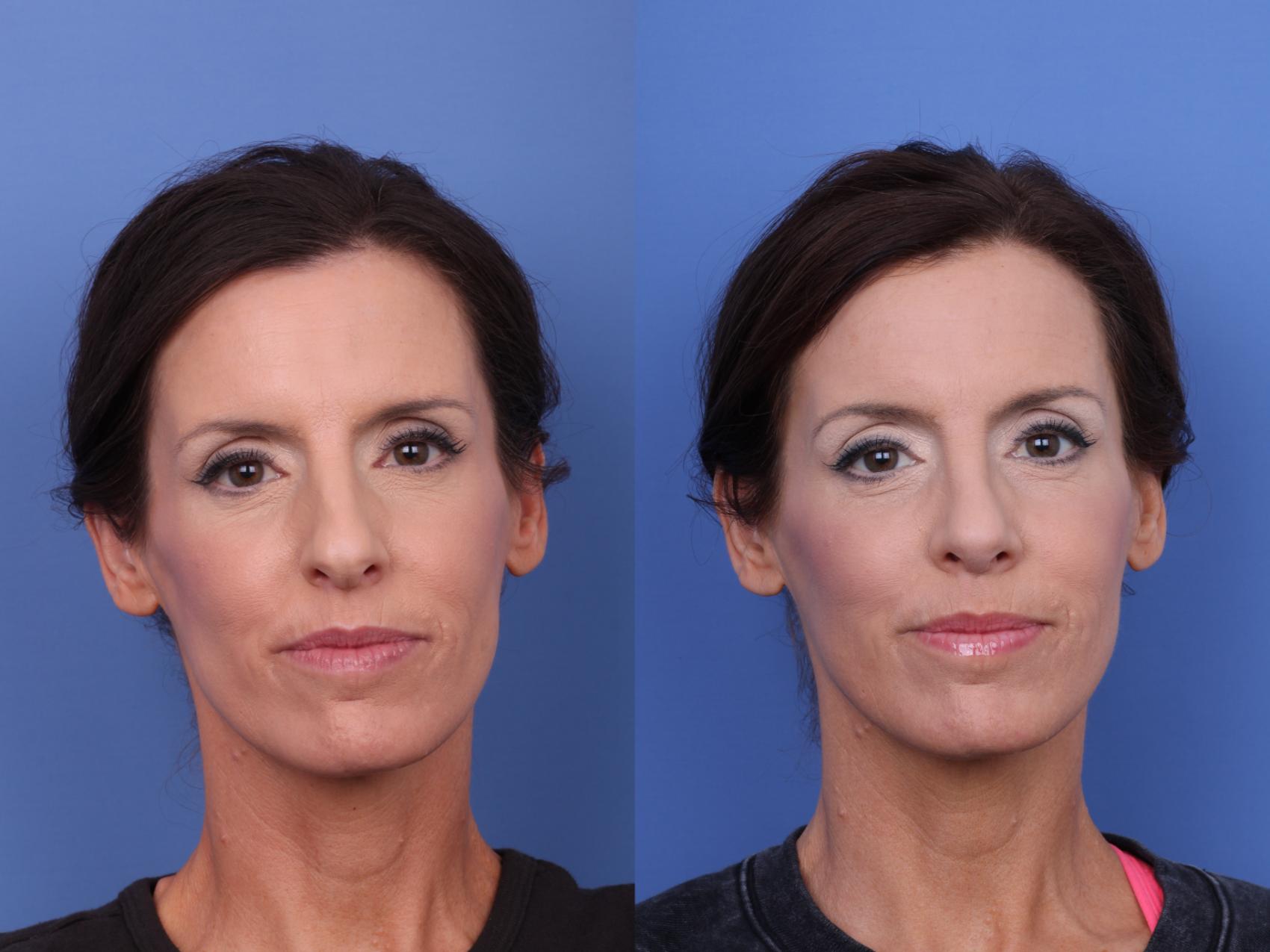 Before & After Rhinoplasty Case 653 Front View in Scottsdale, AZ