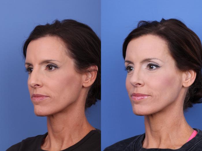 Rhinoplasty Before & After Photo | Scottsdale & Phoenix, AZ | Hobgood Facial Plastic Surgery: Todd Hobgood, MD