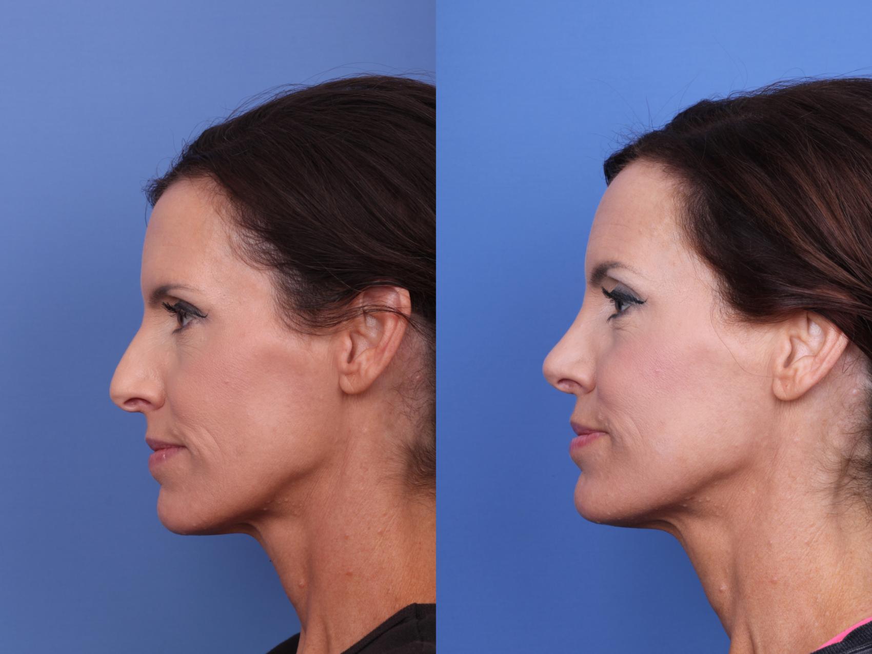 Before & After Rhinoplasty Case 653 Left Side View in Scottsdale, AZ