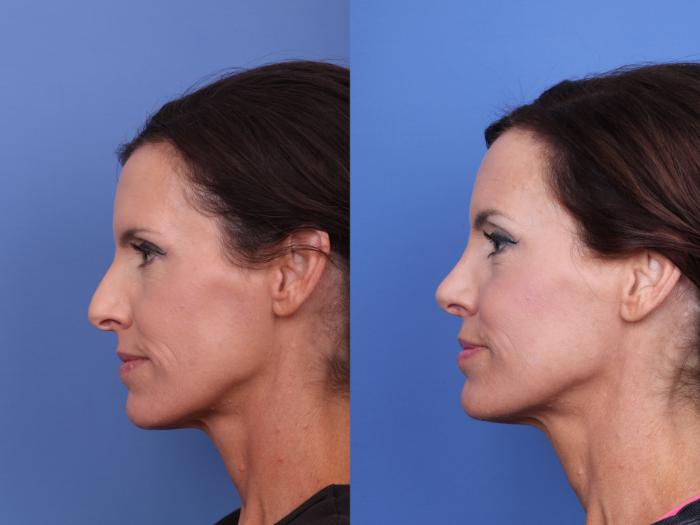 Rhinoplasty Before & After Photo | Scottsdale & Phoenix, AZ | Hobgood Facial Plastic Surgery: Todd Hobgood, MD
