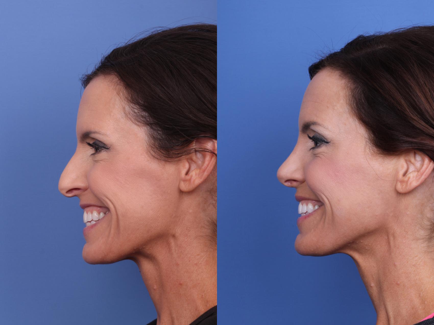 Before & After Rhinoplasty Case 653 Left Smile View in Scottsdale, AZ