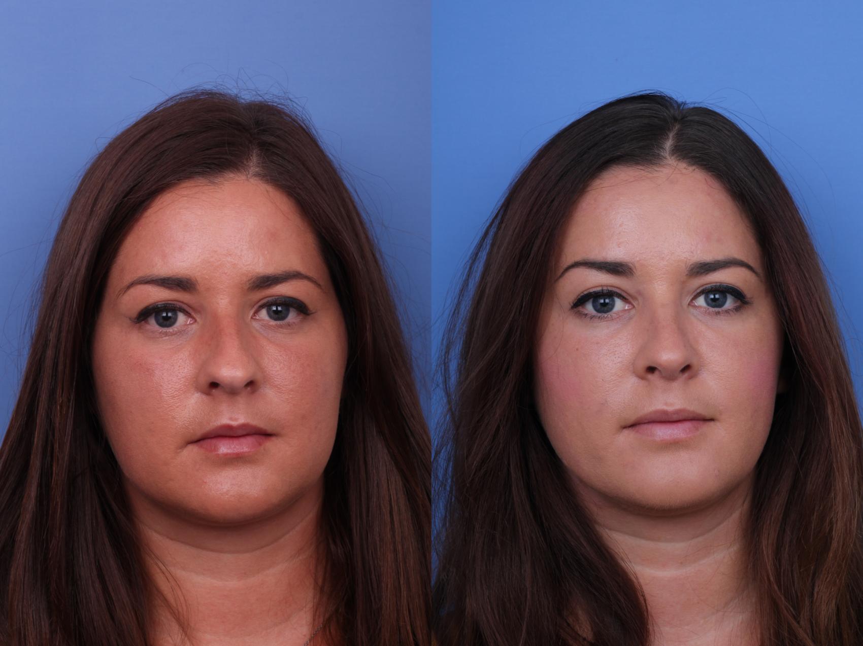 Before & After Rhinoplasty Case 655 Front View in Scottsdale, AZ