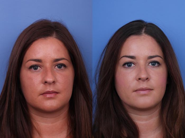 Rhinoplasty Before & After Photo | Scottsdale & Phoenix, AZ | Hobgood Facial Plastic Surgery: Todd Hobgood, MD