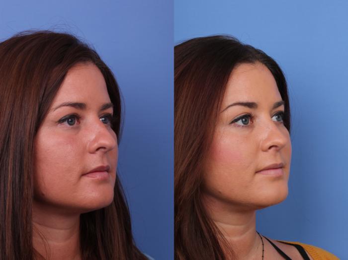Rhinoplasty Before & After Photo | Scottsdale & Phoenix, AZ | Hobgood Facial Plastic Surgery: Todd Hobgood, MD
