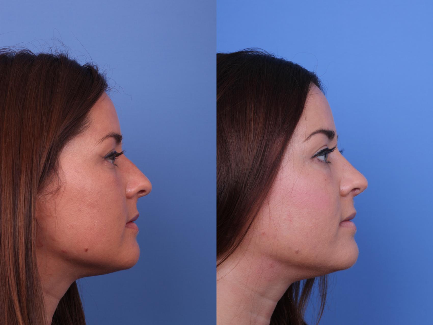 Before & After Rhinoplasty Case 655 Right Side View in Scottsdale, AZ