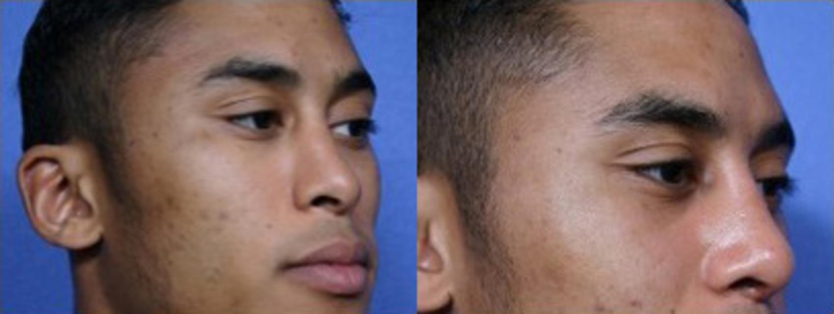 Before & After Rhinoplasty Case 66 View #2 View in Scottsdale, AZ