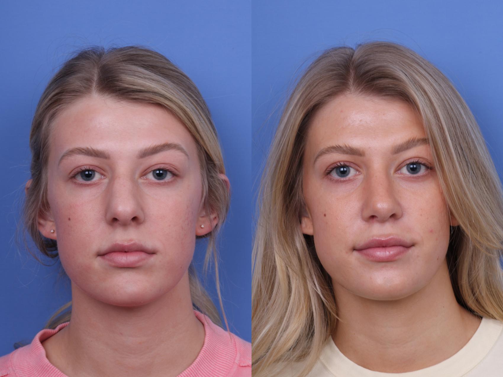 Before & After Rhinoplasty Case 660 Front View in Scottsdale, AZ