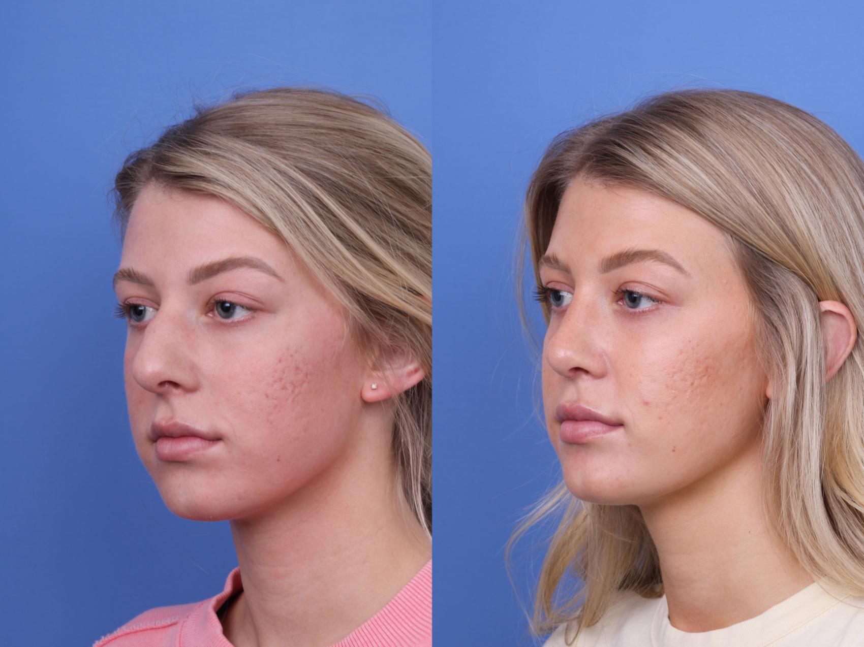 Before & After Rhinoplasty Case 660 Left Oblique View in Scottsdale, AZ