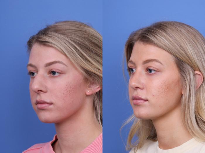 Before & After Rhinoplasty Case 660 Left Oblique View in Scottsdale, AZ