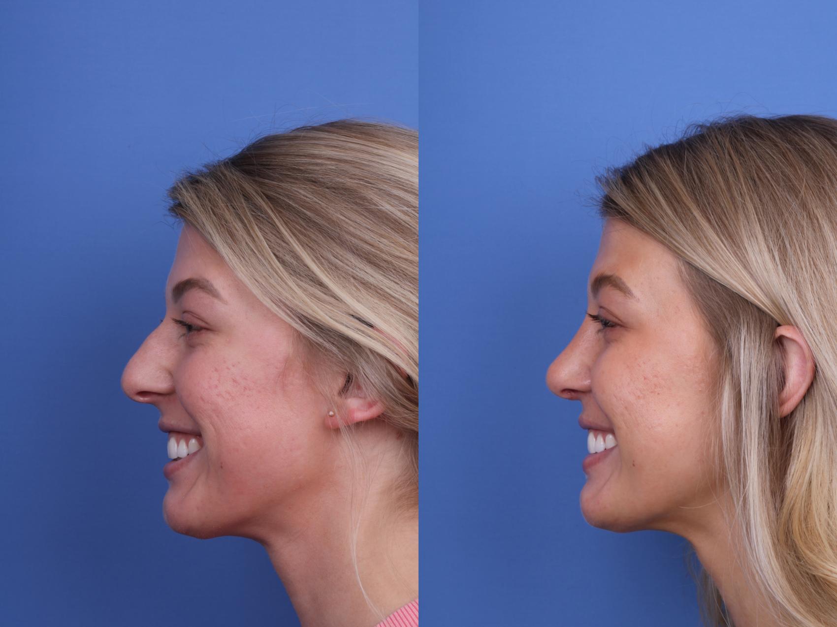 Before & After Rhinoplasty Case 660 Left Smile View in Scottsdale, AZ