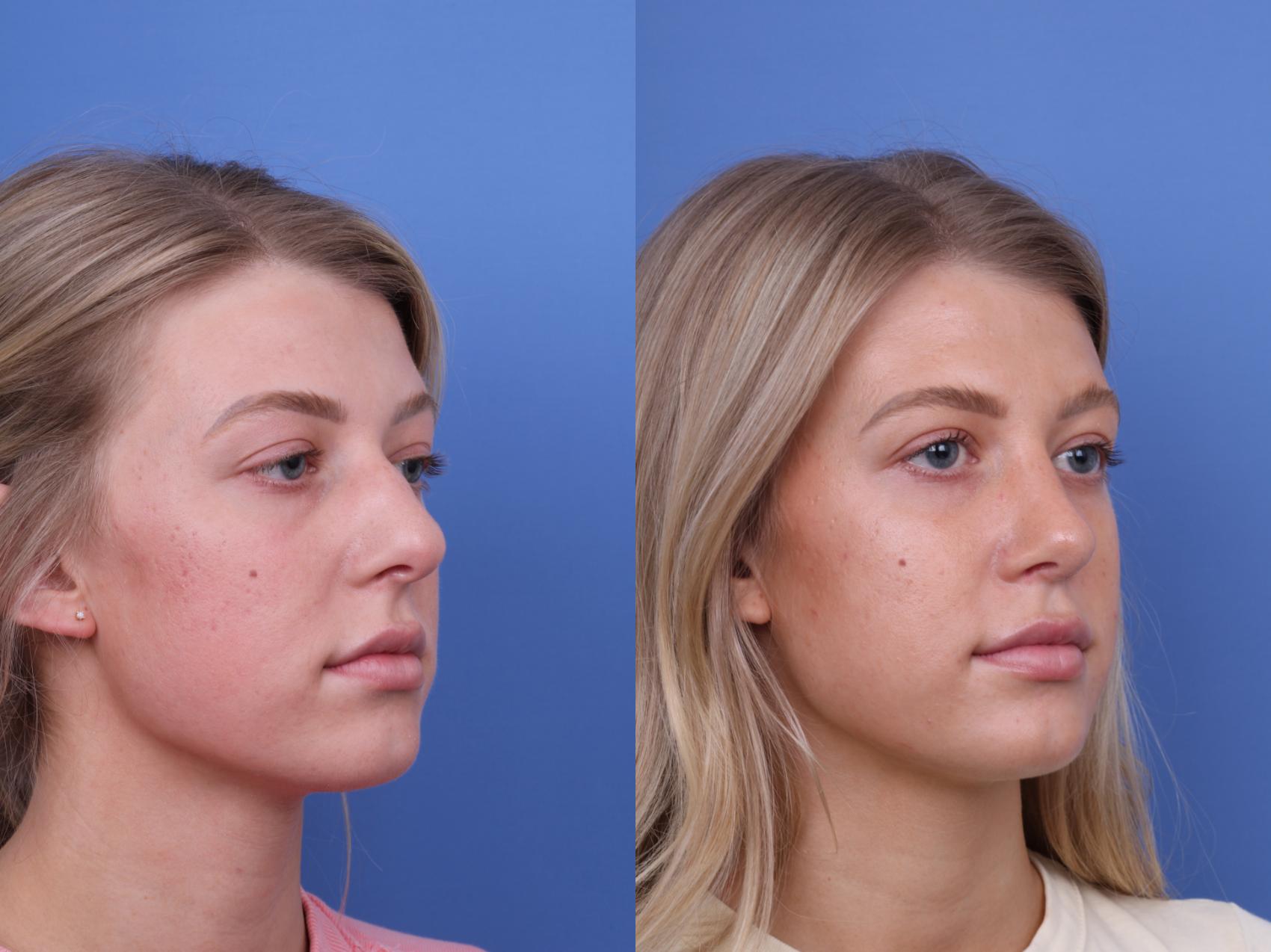 Before & After Rhinoplasty Case 660 Right Oblique View in Scottsdale, AZ