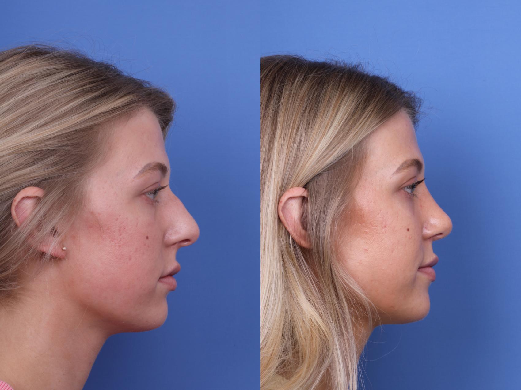 Before & After Rhinoplasty Case 660 Right Side View in Scottsdale, AZ
