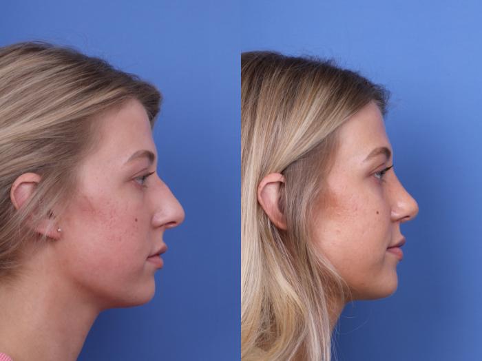 Before & After Rhinoplasty Case 660 Right Side View in Scottsdale, AZ