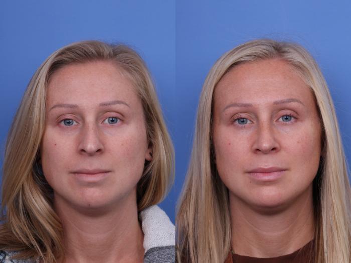 Before & After Rhinoplasty Case 664 Front View in Scottsdale, AZ