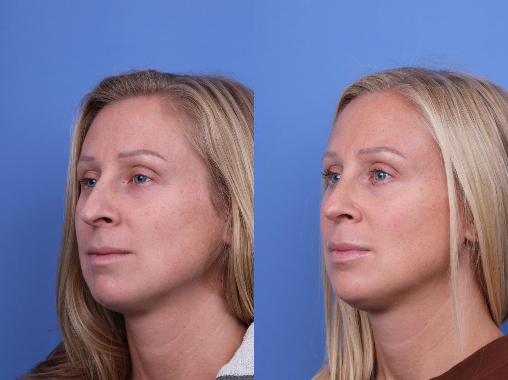 Before & After Rhinoplasty Case 664 Left Oblique View in Scottsdale, AZ