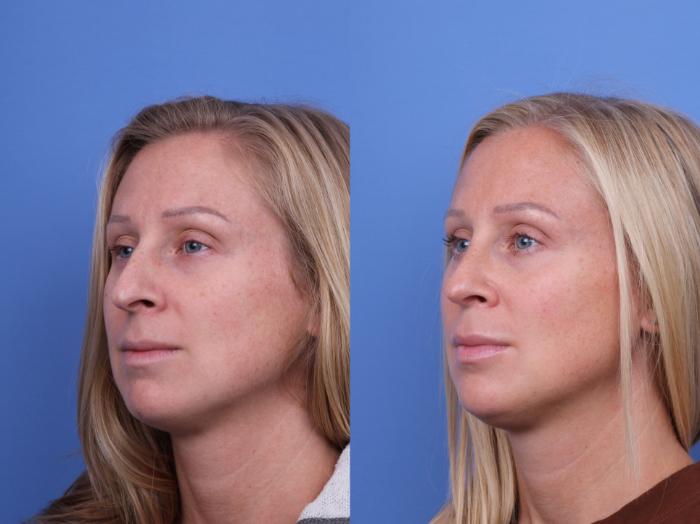 Before & After Rhinoplasty Case 664 Left Oblique View in Scottsdale, AZ