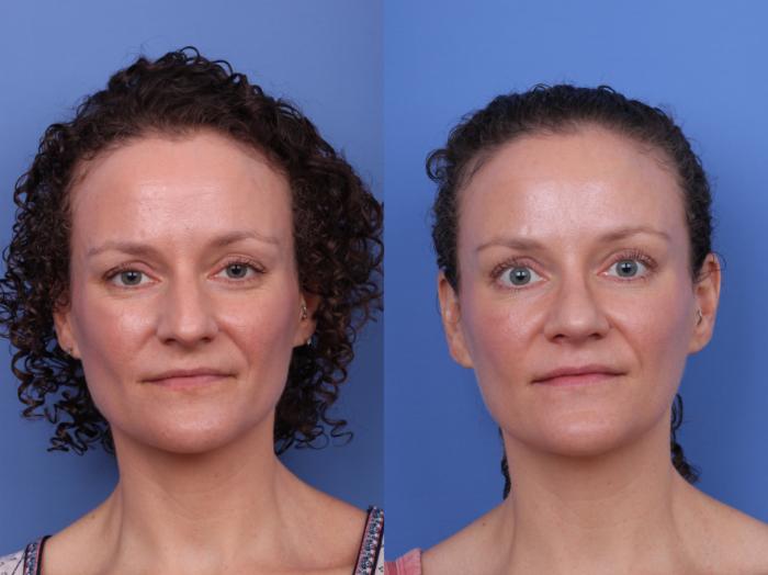 Before & After Rhinoplasty Case 667 Front View in Scottsdale, AZ