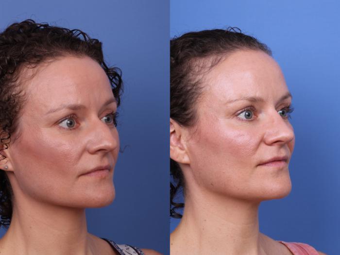 Before & After Rhinoplasty Case 667 Right Oblique View in Scottsdale, AZ
