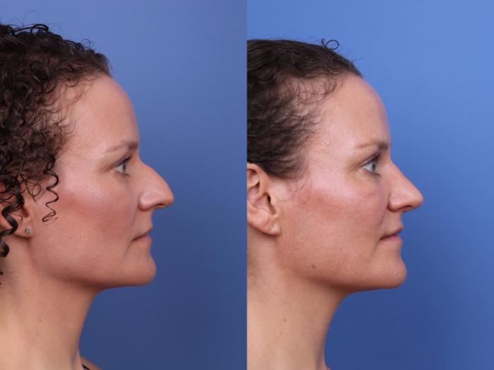 Before & After Rhinoplasty Case 667 Right Side View in Scottsdale, AZ