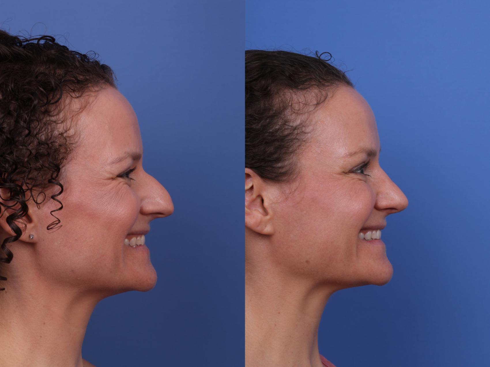 Before & After Rhinoplasty Case 667 Right Smile View in Scottsdale, AZ