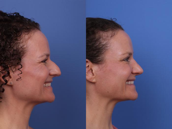 Before & After Rhinoplasty Case 667 Right Smile View in Scottsdale, AZ