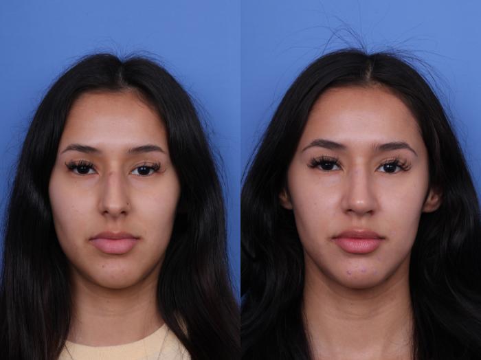 Before & After Rhinoplasty Case 668 Front View in Scottsdale, AZ