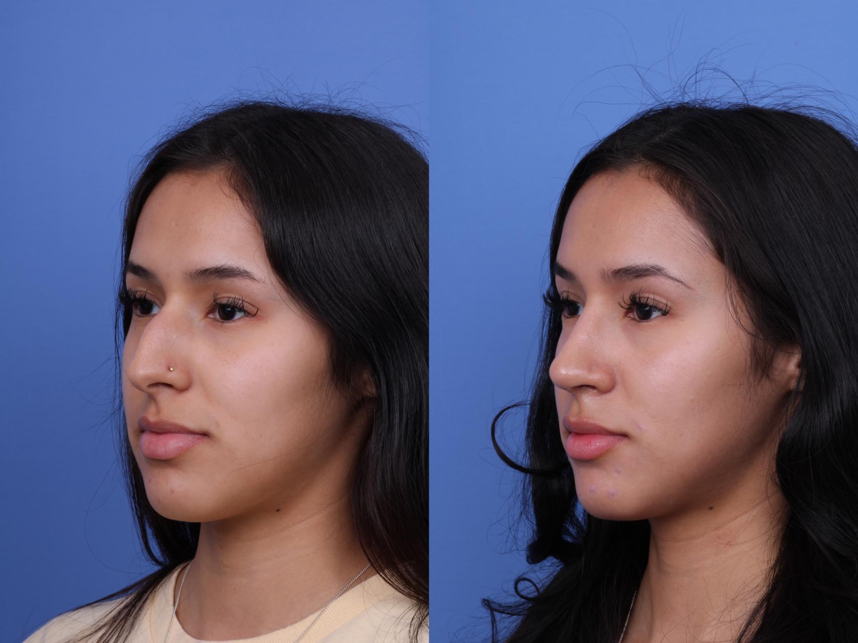 Before & After Rhinoplasty Case 668 Left Oblique View in Scottsdale, AZ