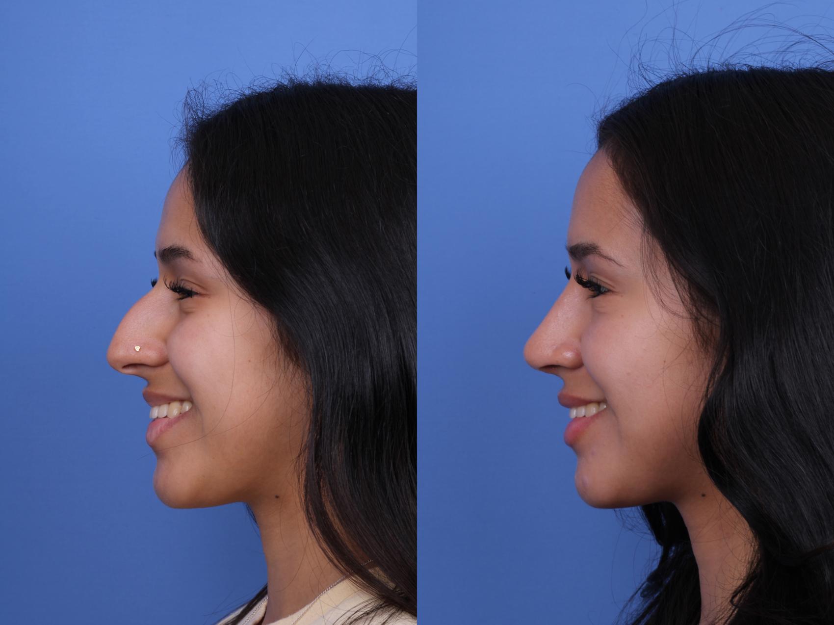 Before & After Rhinoplasty Case 668 Left Smile View in Scottsdale, AZ