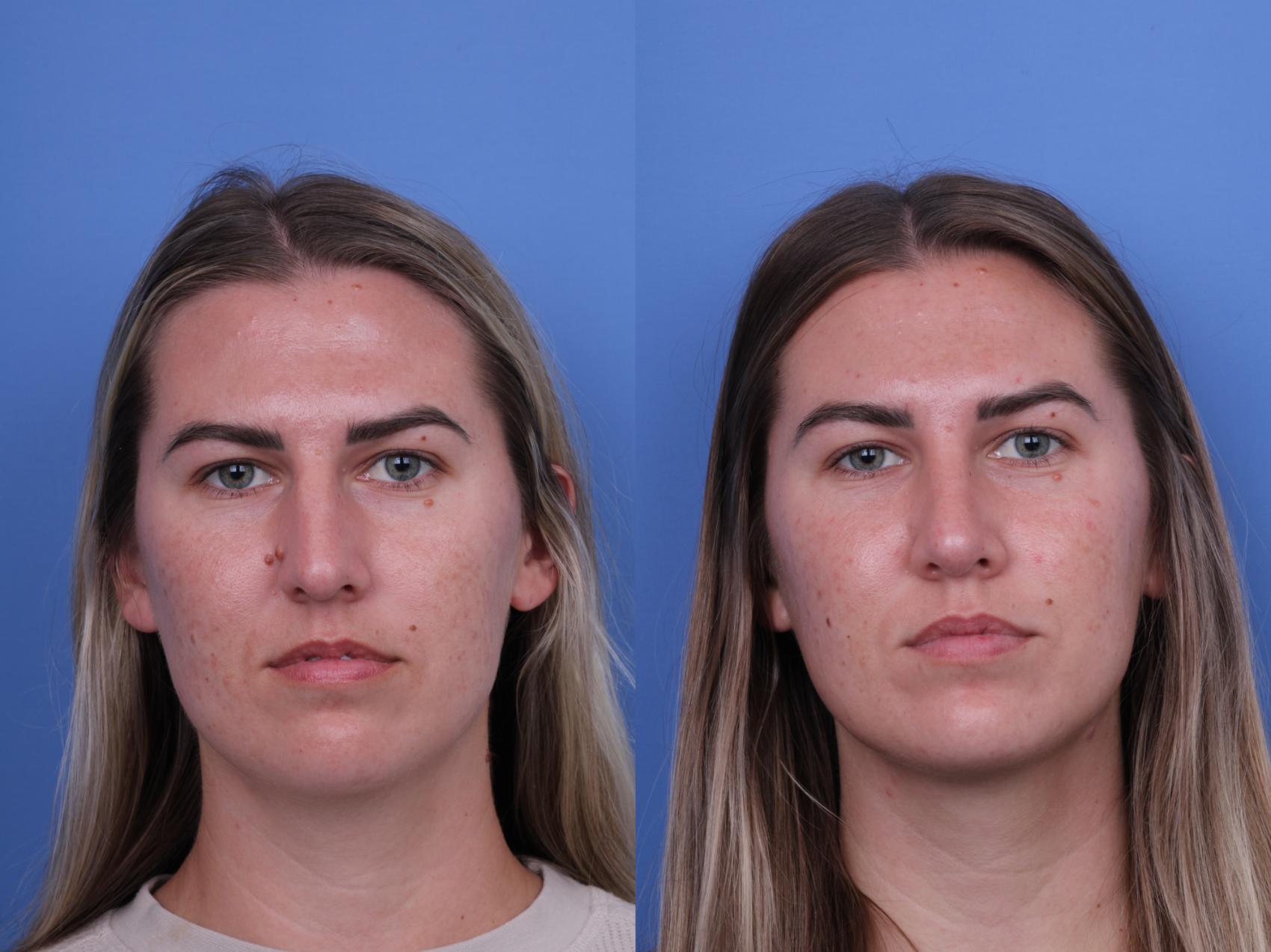 Before & After Rhinoplasty Case 669 Front View in Scottsdale, AZ