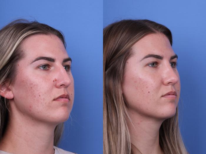 Before & After Rhinoplasty Case 669 Right Oblique View in Scottsdale, AZ