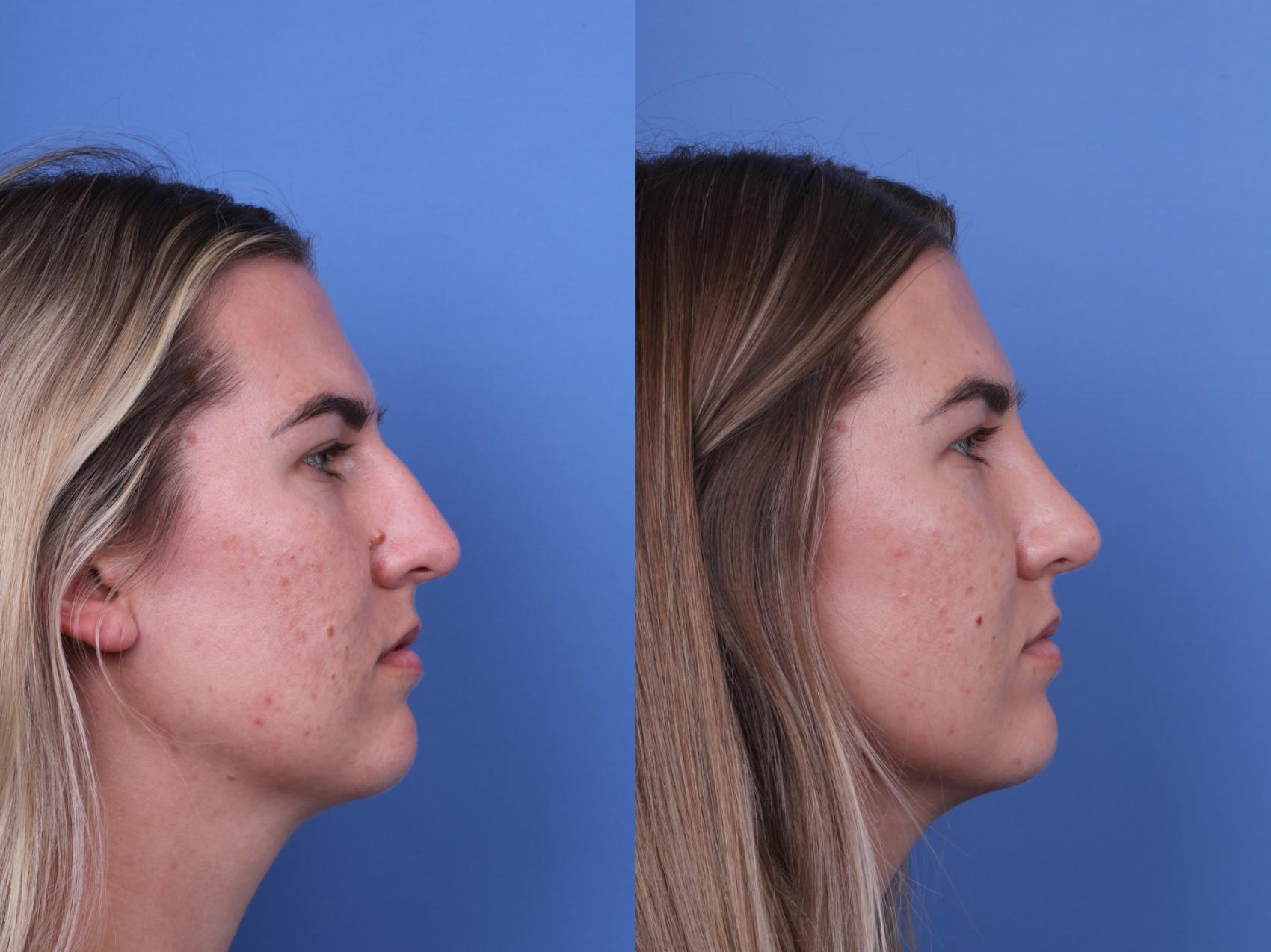 Before & After Rhinoplasty Case 669 Right Side View in Scottsdale, AZ