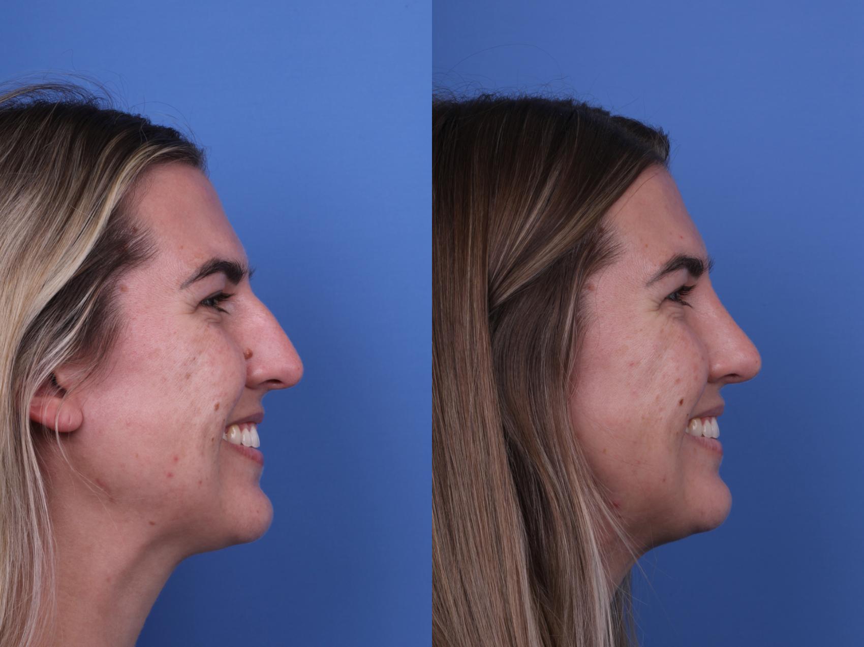 Before & After Rhinoplasty Case 669 Right Smile View in Scottsdale, AZ