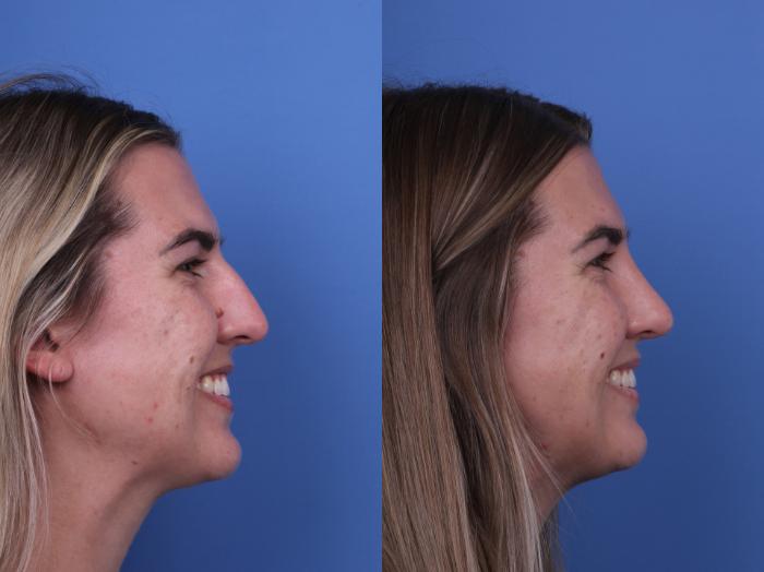 Before & After Rhinoplasty Case 669 Right Smile View in Scottsdale, AZ