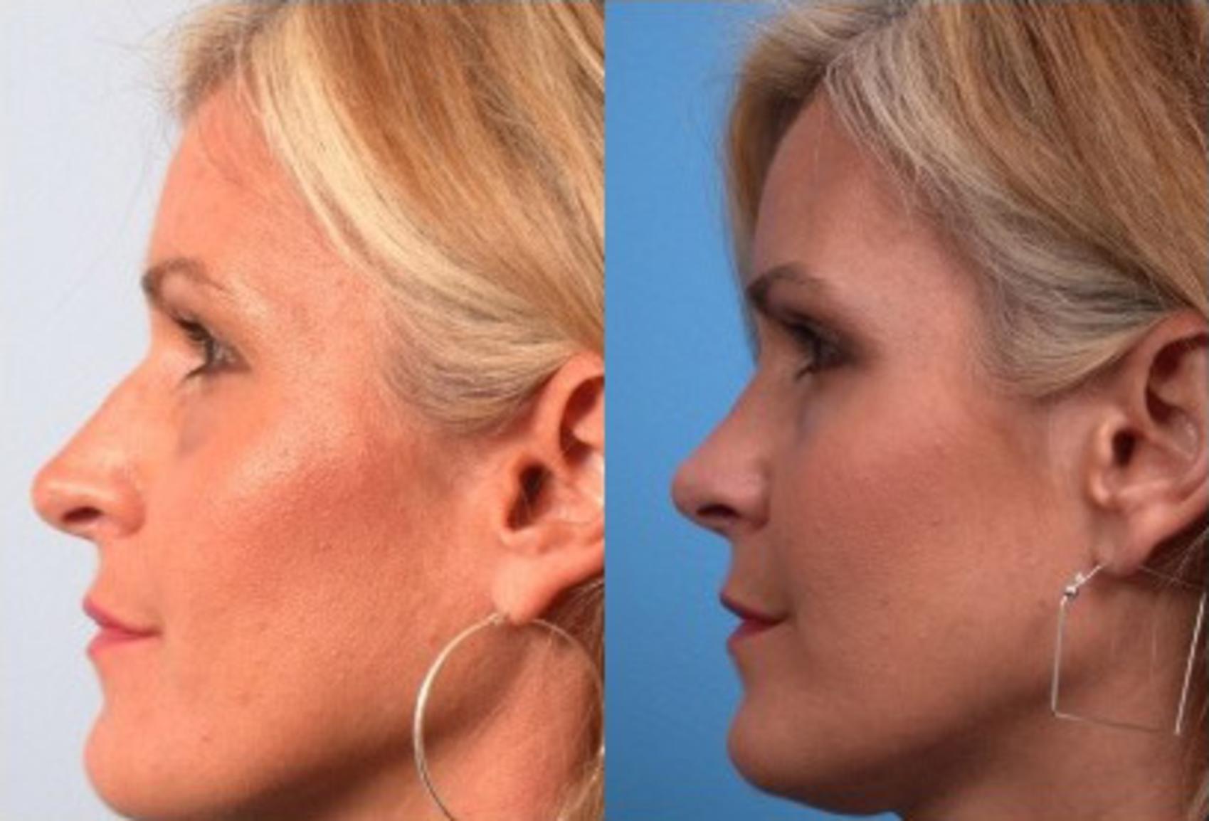 Before & After Rhinoplasty Case 67 View #2 View in Scottsdale, AZ