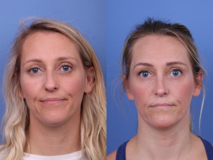 Before & After Rhinoplasty Case 672 Front View in Scottsdale, AZ