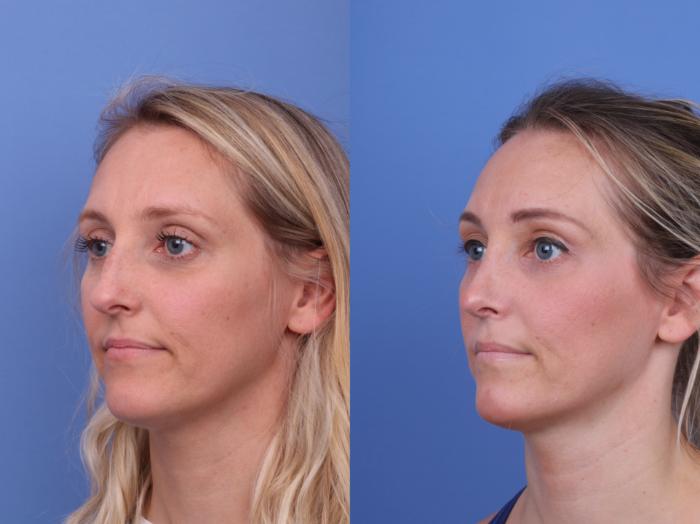 Before & After Rhinoplasty Case 672 Left Oblique View in Scottsdale, AZ