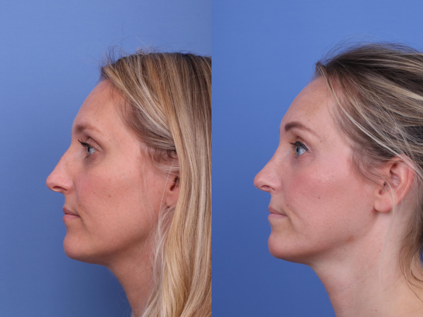 Before & After Rhinoplasty Case 672 Left Side View in Scottsdale, AZ