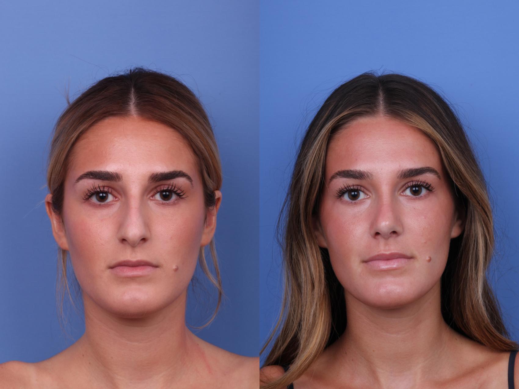 Before & After Rhinoplasty Case 675 Front View in Scottsdale, AZ
