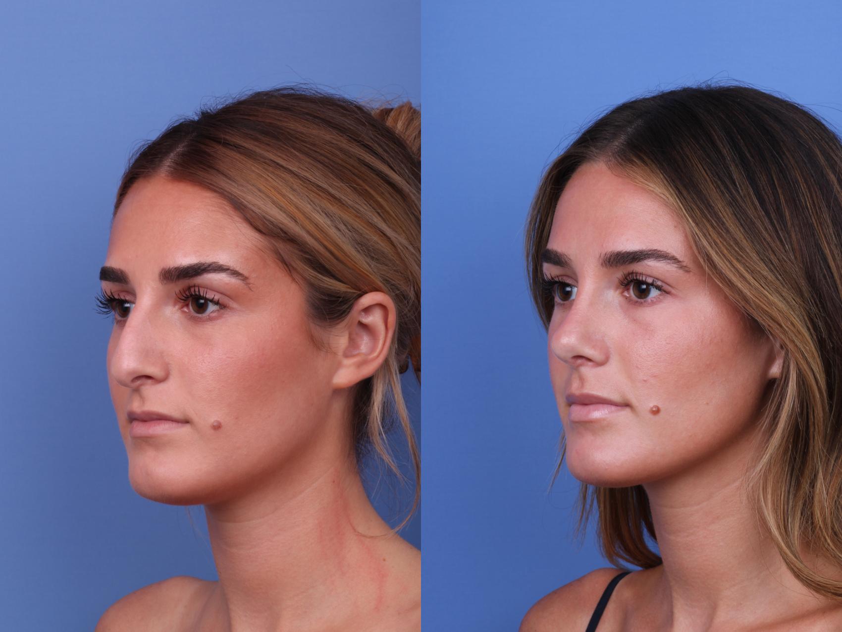 Before & After Rhinoplasty Case 675 Left Oblique View in Scottsdale, AZ