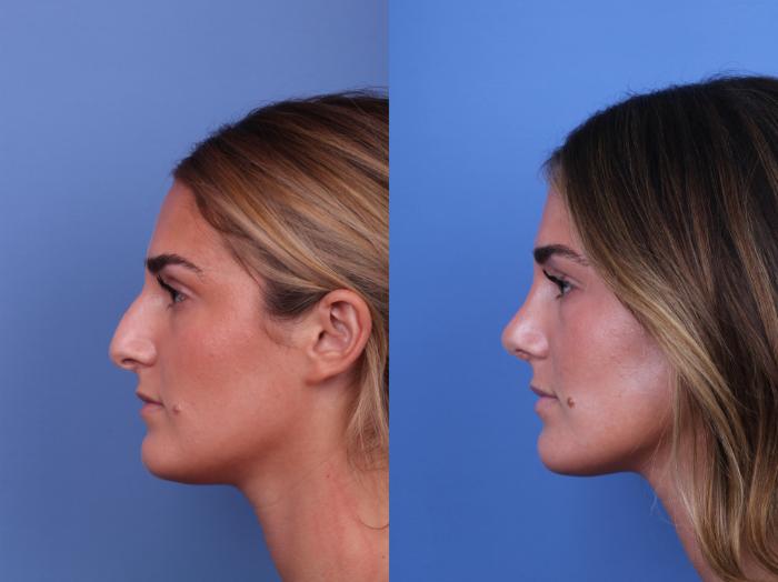 Before & After Rhinoplasty Case 675 Left Side View in Scottsdale, AZ