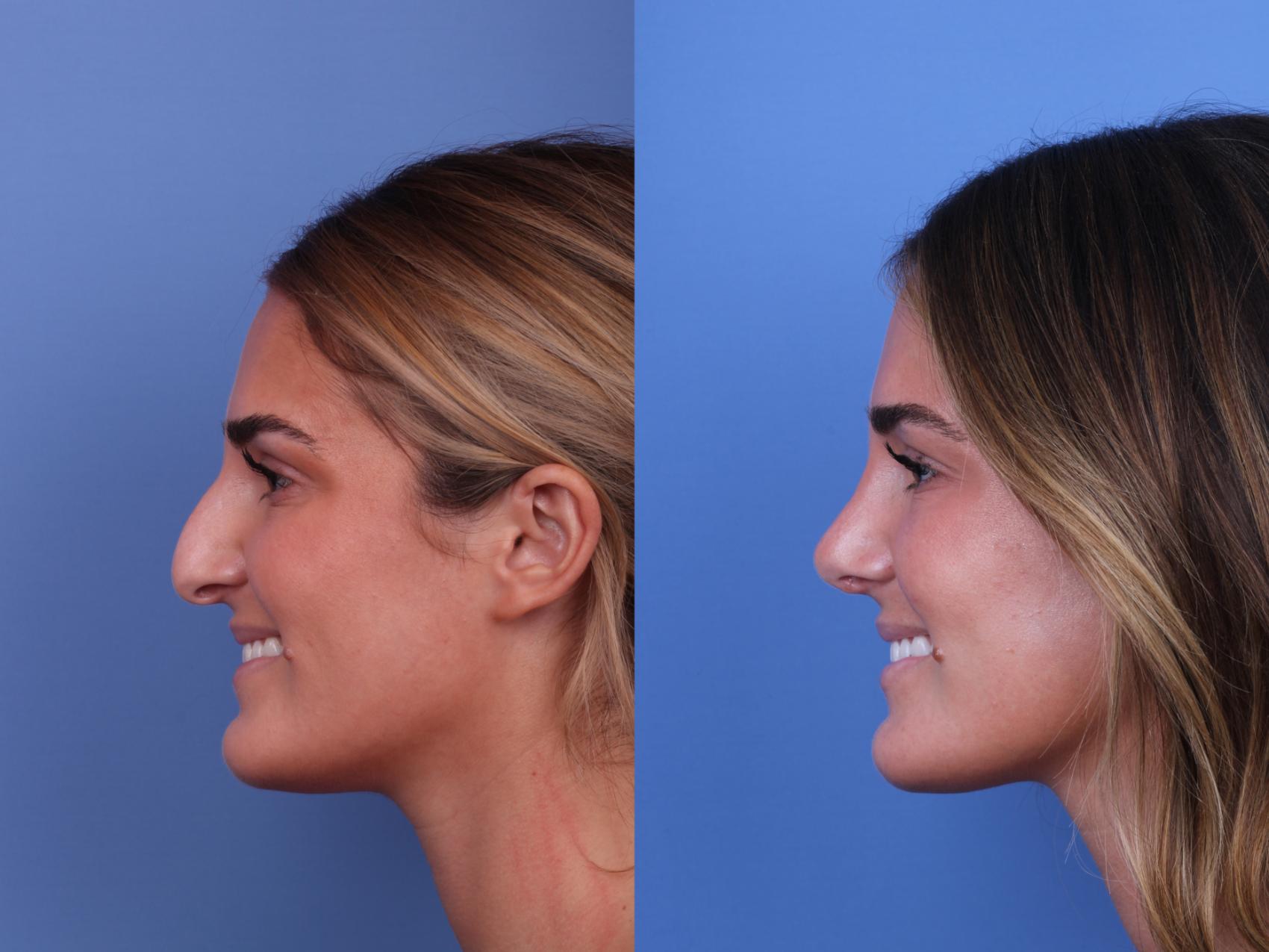 Before & After Rhinoplasty Case 675 Left Smile View in Scottsdale, AZ