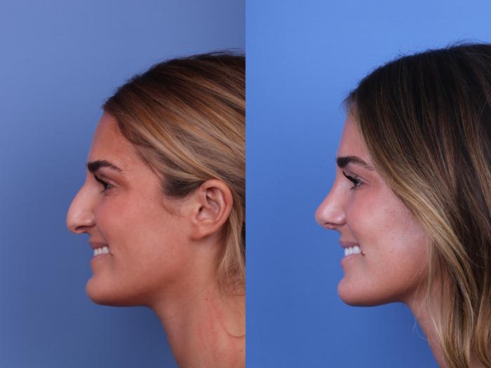 Before & After Rhinoplasty Case 675 Left Smile View in Scottsdale, AZ